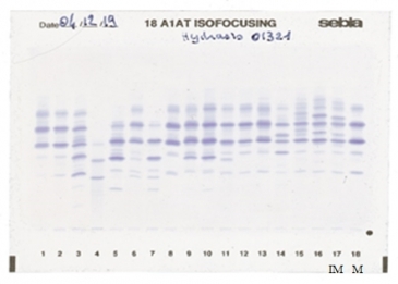 IEF pattern on agarose gel : I in lane 17