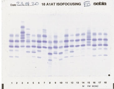 IEF pattern on agarose gel : FM in Lane 15