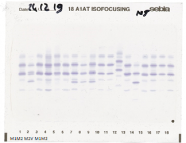 IEF pattern on agarose gel: V in lane 2