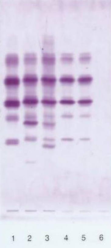 AAT phenotyping by IEF on agarose gel. The index case is in lane 6 (no band).; lane1: MM control; lane 2: MS control; lane 3: MZ control; lane4 and 5: Q0ourém in heterozygous state