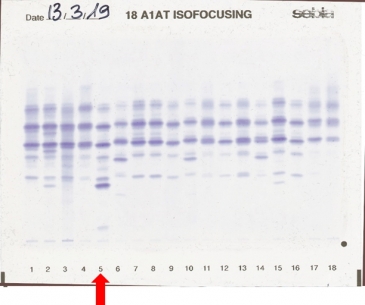 IEF pattern on agarose gel : MZbristol in lane 5