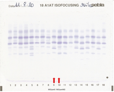 IEF pattern on agarose gel : M1lyonS in lane 9 and M1lyonM2 in lane 10