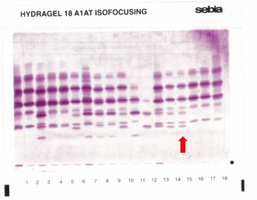 IEF pattern on agarose gel : M1lyonZ in lane 15