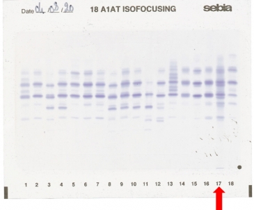 IEF pattern on agarose gel : Mmalton in lane 17