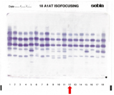 IEF on agarose gel : in lane 12
