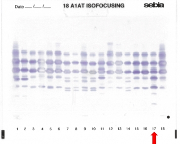 IEF pattern on agarose gel : Xchristchurch in lane 17