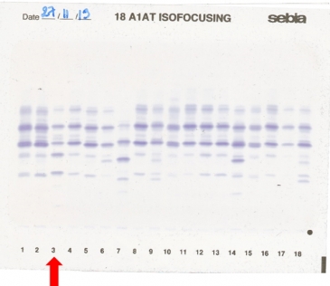 IEF pattern on agarose gel : Xchristchurch in lane 3