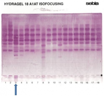 IEF on agarose gel : M1 bruxelles variant in lane 3